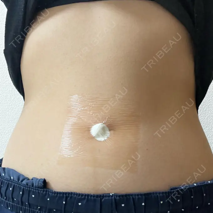 へそ形成 藤・ナチュレ美容クリニック 銀座院 DAY 1 メイン用