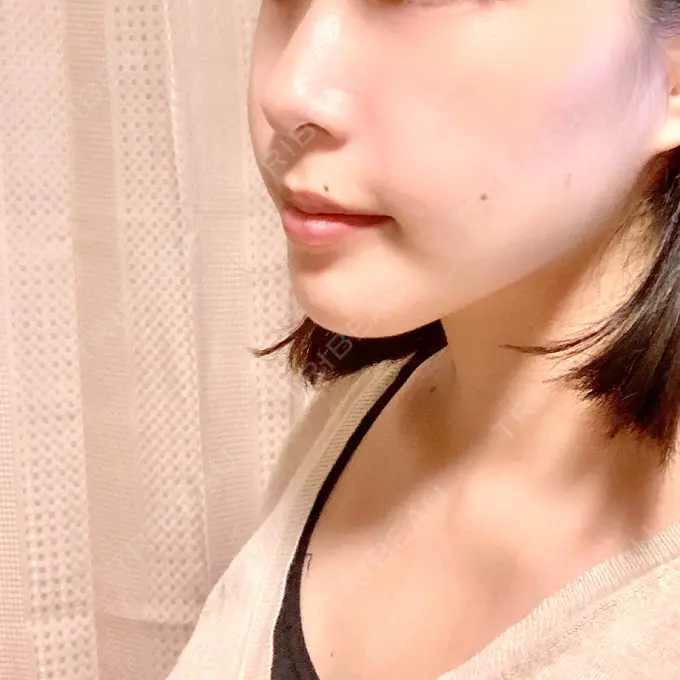 セットバック 大塚美容形成外科・歯科 大塚本院 DAY 104 メイン用