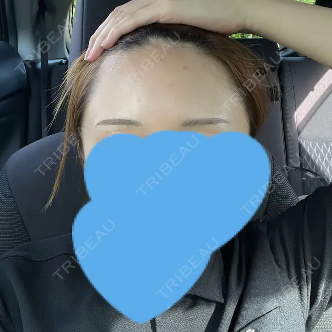 ヒアルロン酸注入（額） アモーレクリニック 名古屋院 DAY 2 メイン用