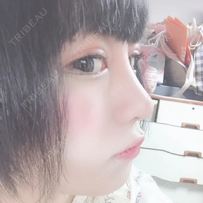 隆鼻術 / 鼻中隔延長（切開） / 鼻孔縁挙上 プリモ麻布十番クリニック DAY 28 メイン用