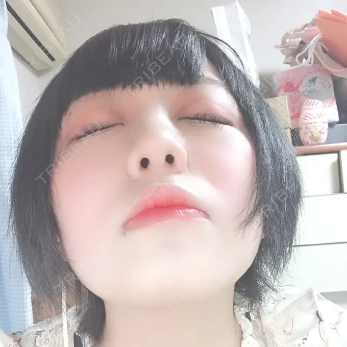 隆鼻術 / 鼻中隔延長（切開） / 鼻孔縁挙上 プリモ麻布十番クリニック DAY 28 メイン用