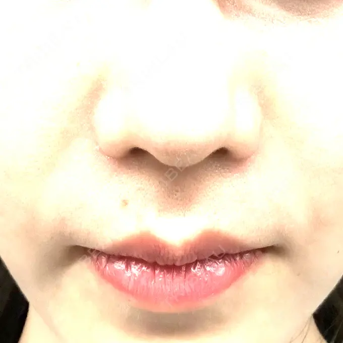 ハイフ（顔） クレオビューティークリニック DAY 4 メイン用