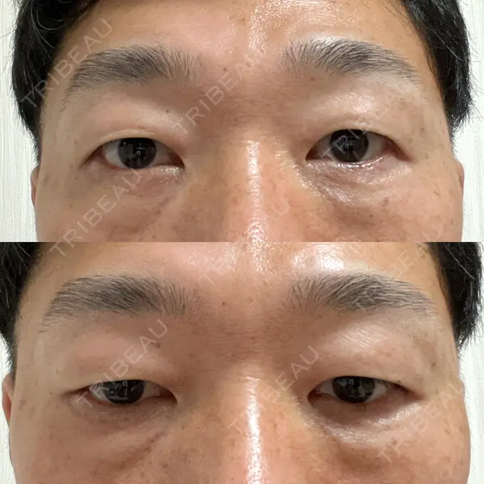 クマ治療 / 下まぶたの脂肪取り ROOTS Clinic DAY 0 メイン用