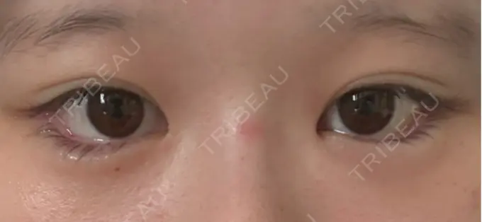 目尻切開 / タレ目形成・グラマラスライン（埋没） LOUIS CLINIC 二子玉川院【ルイクリニック】 DAY 1 メイン用