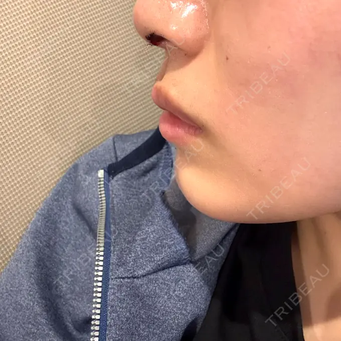 鼻尖形成（切開） ネビュラクリニック 京都院 DAY 1 メイン用