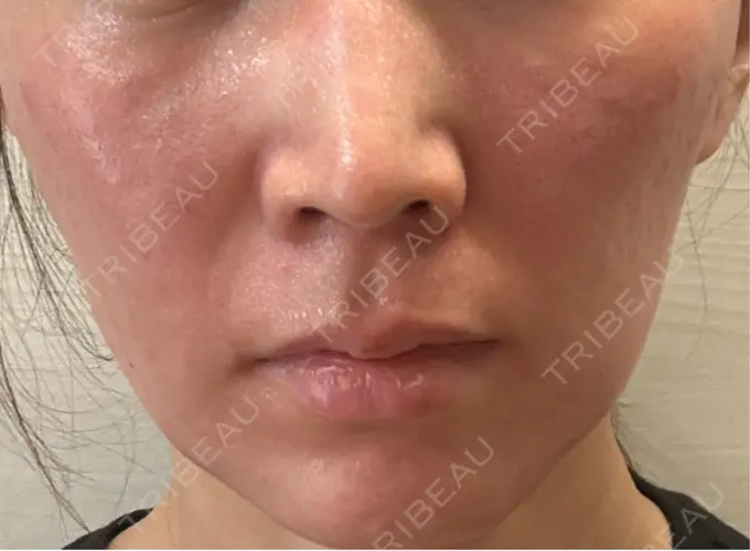 肌育注射（ジュベルックなど） / その他（肌） ゆきスキンクリニック 東池袋 DAY 0 メイン用