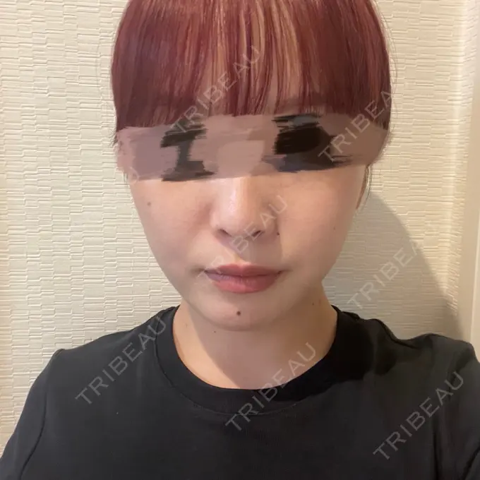 ボトックス（エラ・小顔） LIBER CLINIC DAY 0 メイン用