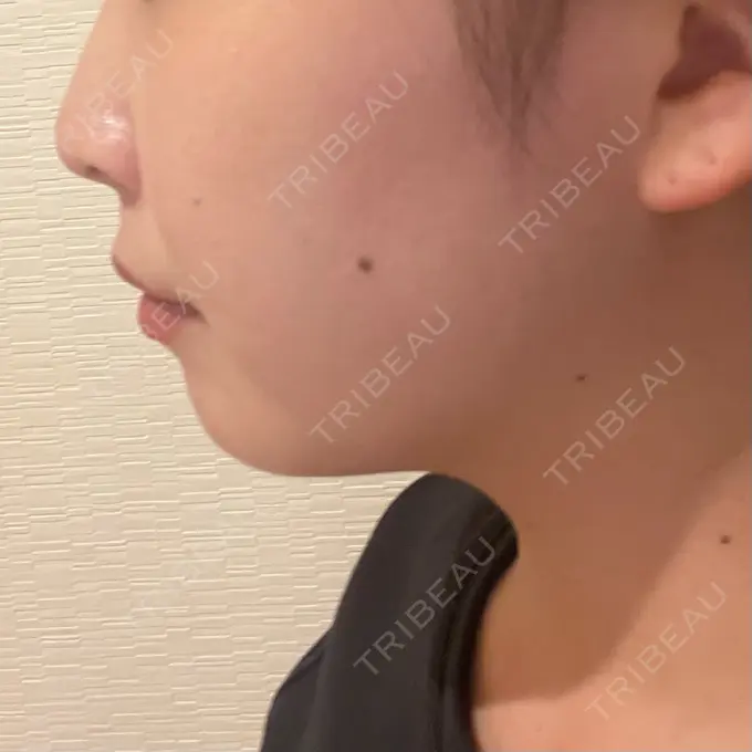 ボトックス（エラ・小顔） LIBER CLINIC DAY 0 メイン用