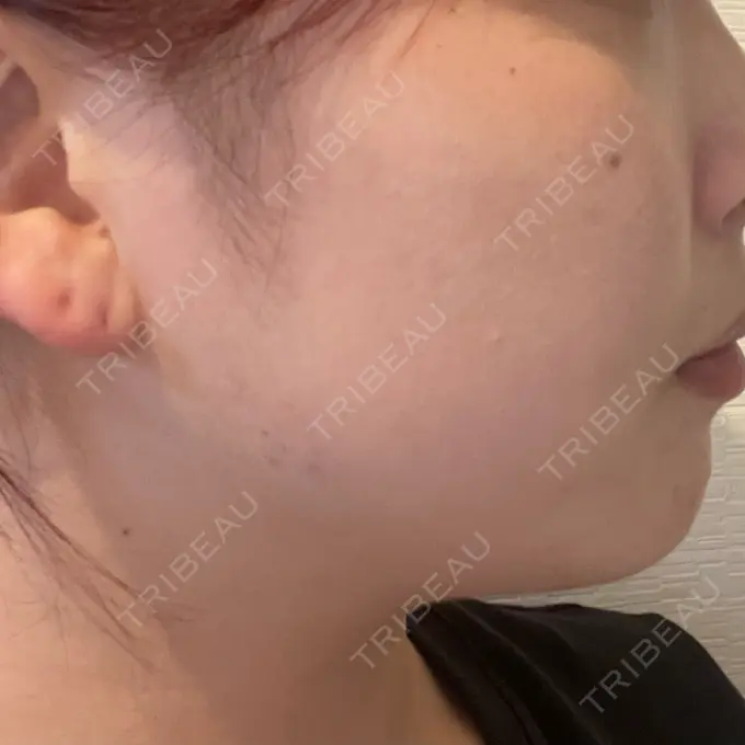 ボトックス（エラ・小顔） LIBER CLINIC DAY 0 メイン用