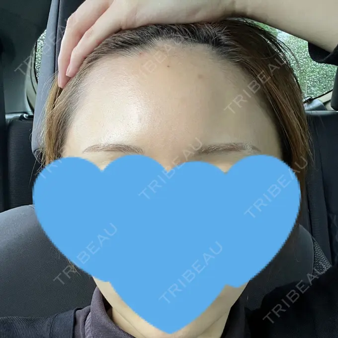 ヒアルロン酸注入（額） アモーレクリニック 名古屋院 DAY 3 メイン用