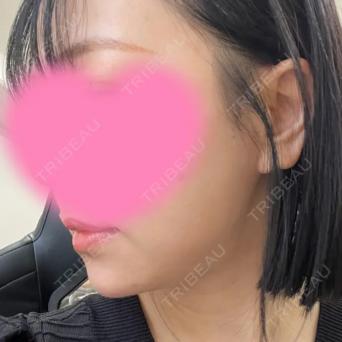 ボトックス（あご） / ボトックス（エラ・小顔） / ボトックス（口角） eクリニック 大阪院 DAY 0 メイン用