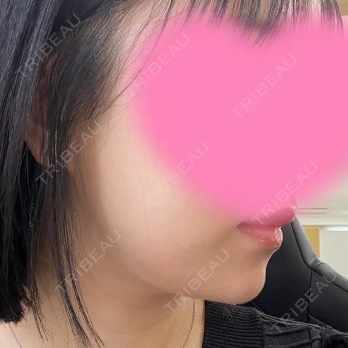 ボトックス（あご） / ボトックス（エラ・小顔） / ボトックス（口角） eクリニック 大阪院 DAY 0 メイン用