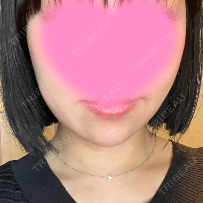 ボトックス（あご） / ボトックス（エラ・小顔） / ボトックス（口角） eクリニック 大阪院 DAY 0 メイン用