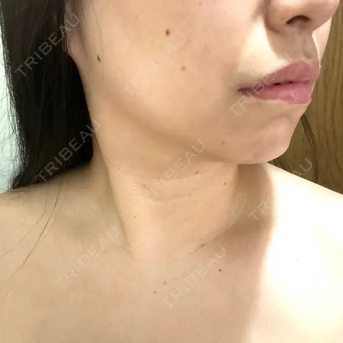 その他（輪郭） ルラ美容クリニック 渋谷本院 DAY 6 メイン用