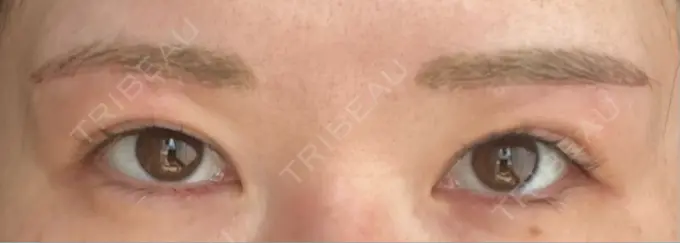 眉下切開 / ボトックス（眉間） / ボトックス（額） 銀座リシェスクリニック DAY 8 メイン用