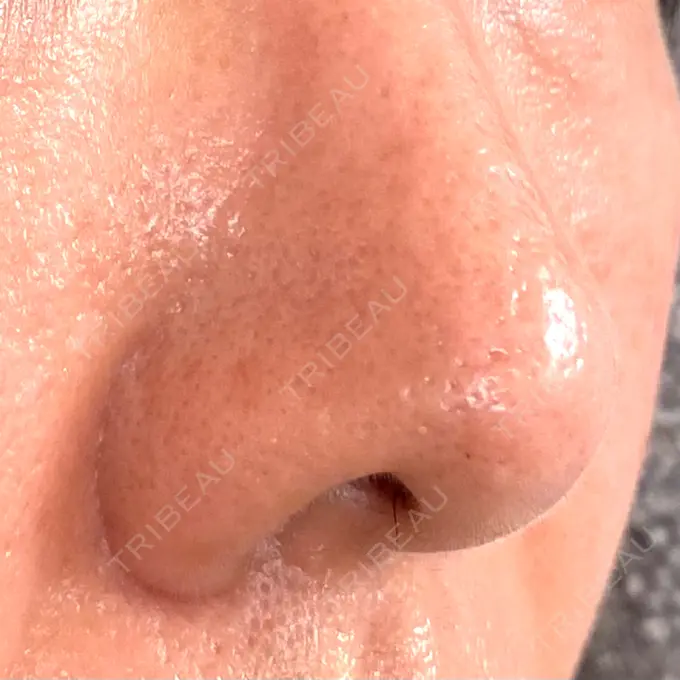 サブシジョン / 肌育注射（ジュベルックなど） / その他（肌） ゆきスキンクリニック 東池袋 AFTER メイン用