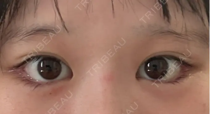 目尻切開 / タレ目形成・グラマラスライン（埋没） LOUIS CLINIC 二子玉川院【ルイクリニック】 DAY 2 メイン用