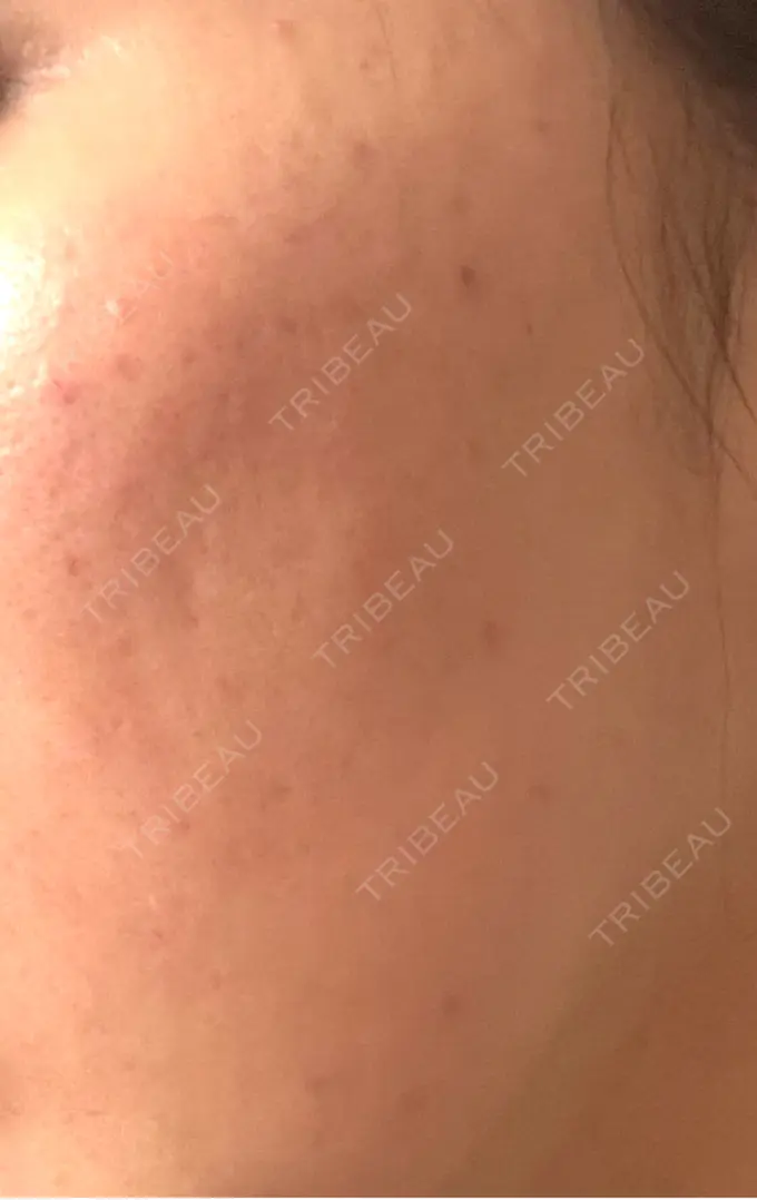 肌育注射（ジュベルックなど） / その他（肌） ゆきスキンクリニック 東池袋 DAY 1 メイン用