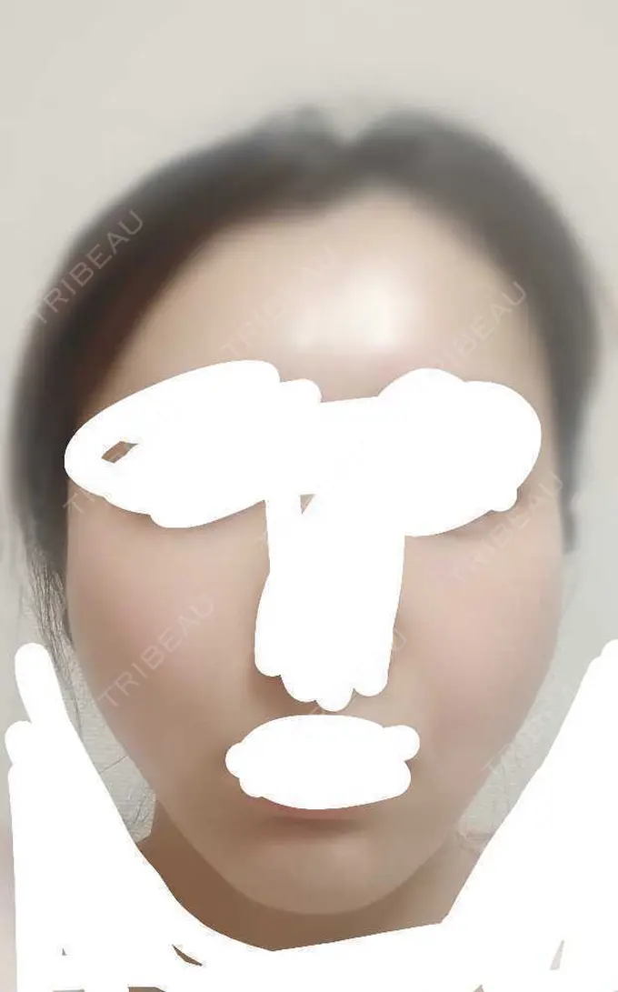 糸リフト アリエル美容クリニック 横浜院 DAY 6 メイン用