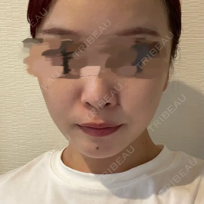 ボトックス（エラ・小顔） LIBER CLINIC DAY 1 メイン用