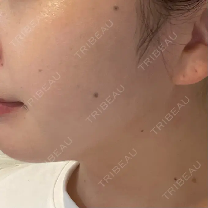 ボトックス（エラ・小顔） LIBER CLINIC DAY 1 メイン用