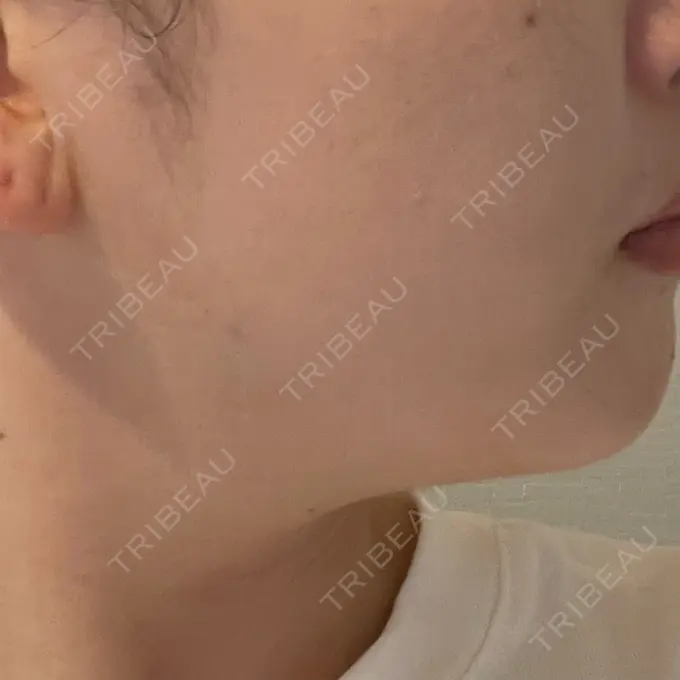 ボトックス（エラ・小顔） LIBER CLINIC DAY 1 メイン用