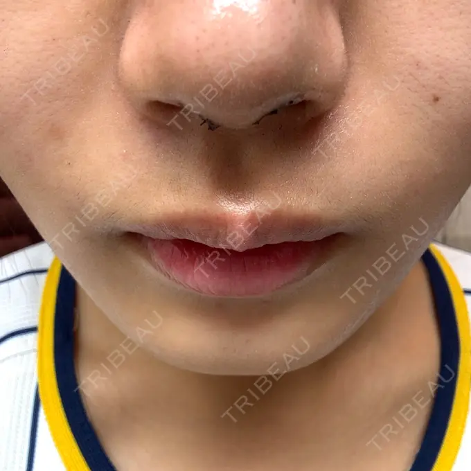 鼻尖形成（切開） ネビュラクリニック 京都院 DAY 2 メイン用