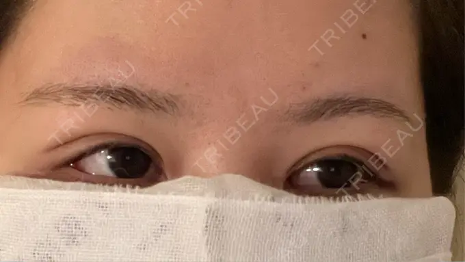 二重埋没 R Beauty CLINIC 銀座院 DAY 1 メイン用