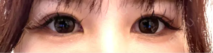 二重埋没 R Beauty CLINIC 銀座院 AFTER メイン用