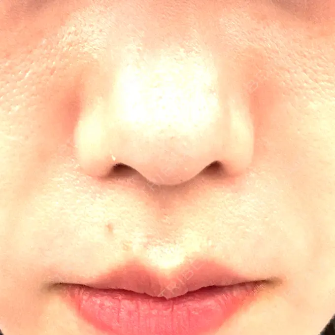 ハイフ（顔） クレオビューティークリニック DAY 7 メイン用