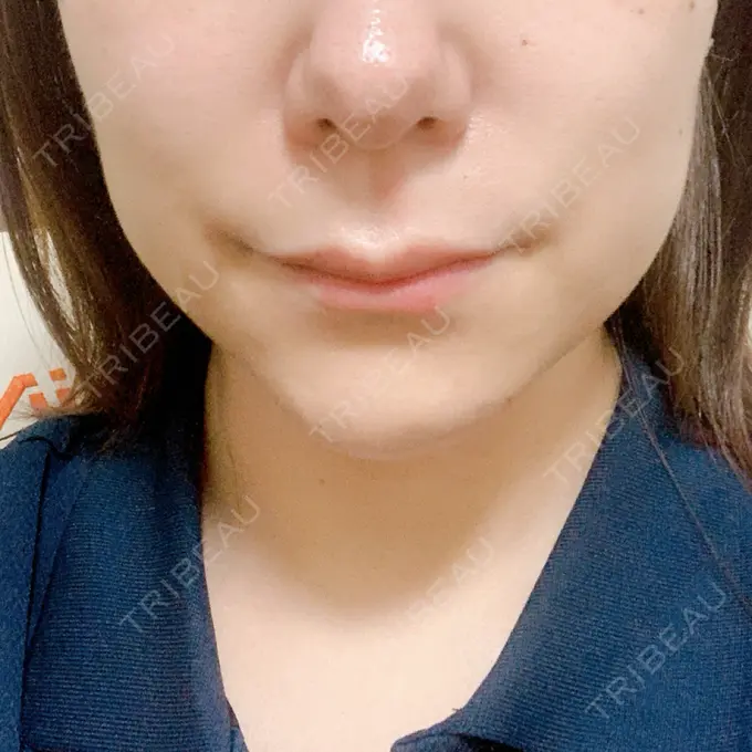 ボトックス（エラ・小顔） / マイクロボトックス / ボトックス（首） / ボトックス（人中） 筋肉・美容クリニック DAY 8 メイン用