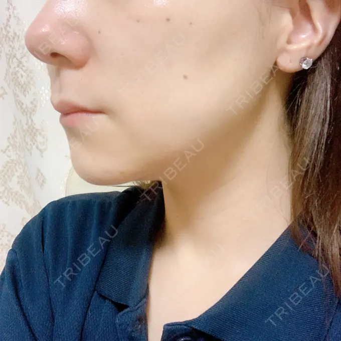 ボトックス（エラ・小顔） / マイクロボトックス / ボトックス（首） / ボトックス（人中） 筋肉・美容クリニック DAY 8 メイン用