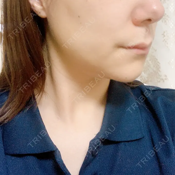 ボトックス（エラ・小顔） / マイクロボトックス / ボトックス（首） / ボトックス（人中） 筋肉・美容クリニック DAY 8 メイン用