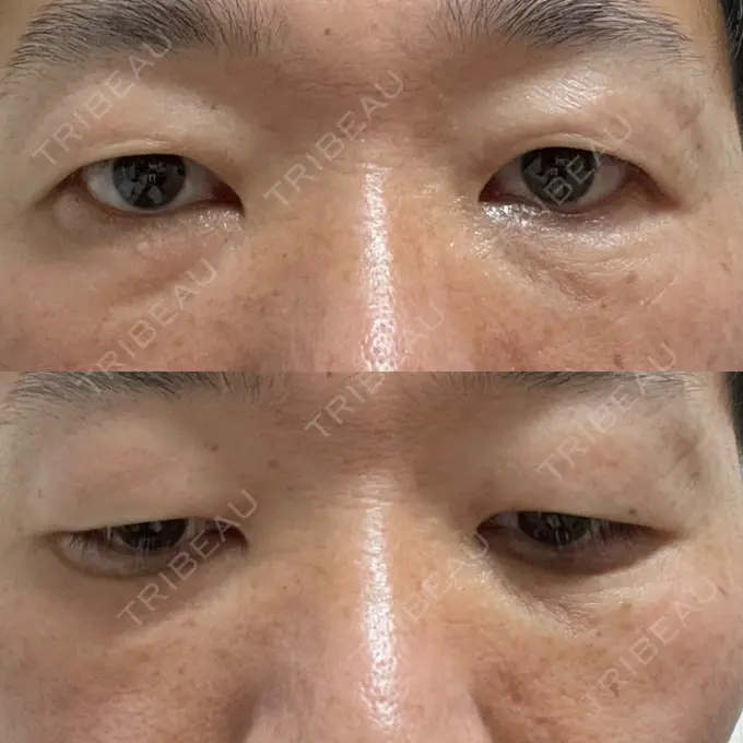 クマ治療 / 下まぶたの脂肪取り ROOTS Clinic DAY 2 メイン用