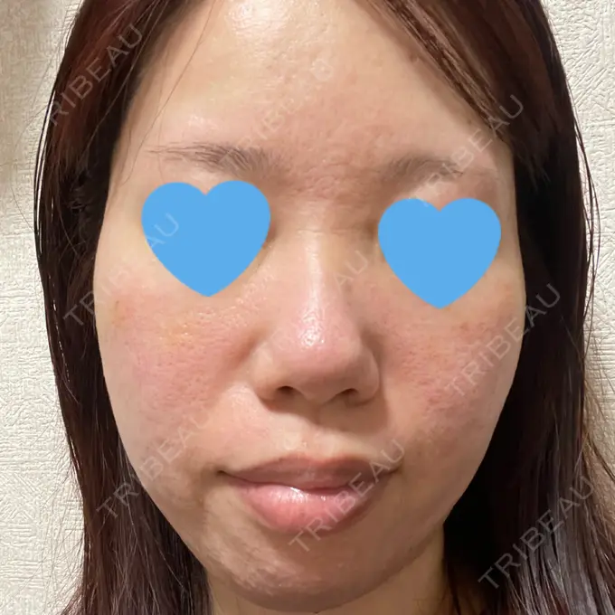 マイクロボトックス / 肌育注射（ジュベルックなど） ミニマムスキンクリニック池袋 DAY 6 メイン用