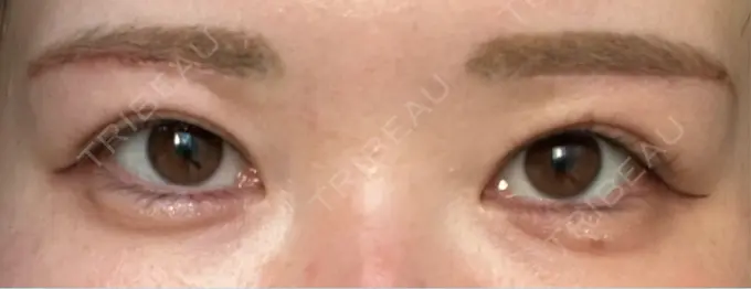 眉下切開 / ボトックス（眉間） / ボトックス（額） 銀座リシェスクリニック DAY 9 メイン用