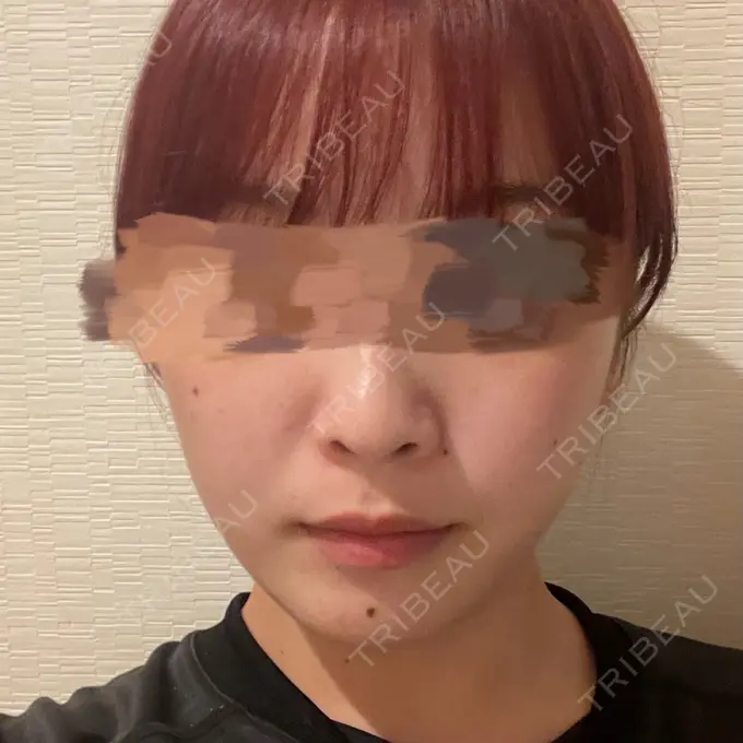 ボトックス（エラ・小顔） LIBER CLINIC AFTER メイン用