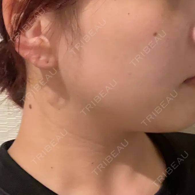 ボトックス（エラ・小顔） LIBER CLINIC DAY 2 メイン用