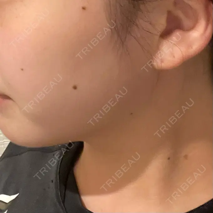 ボトックス（エラ・小顔） LIBER CLINIC DAY 2 メイン用