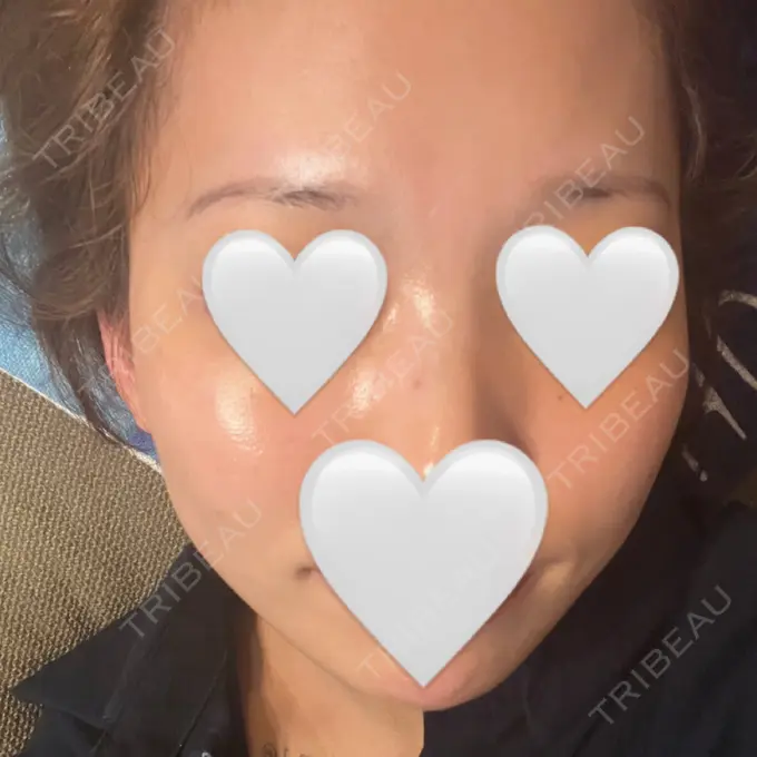 RF（高周波）たるみ治療 TUNE CLINIC【チューンクリニック】 AFTER メイン用