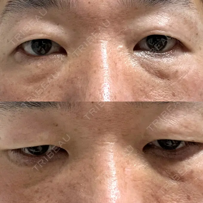 クマ治療 / 下まぶたの脂肪取り ROOTS Clinic DAY 3 メイン用