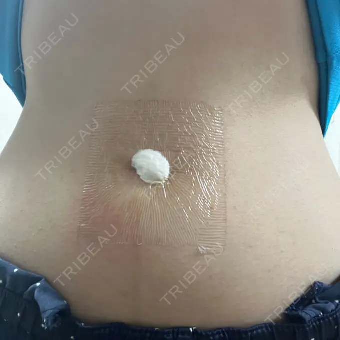 へそ形成 藤・ナチュレ美容クリニック 銀座院 DAY 4 メイン用