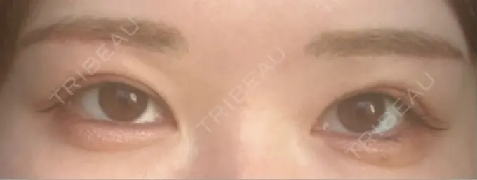 眉下切開 / ボトックス（眉間） / ボトックス（額） 銀座リシェスクリニック DAY 10 メイン用