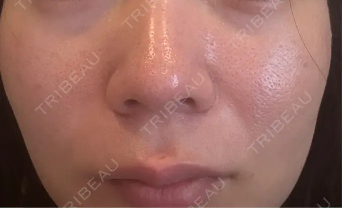 小鼻縮小（非切開） / ワキ汗治療（ボトックス） / ボトックス（目尻） / ボトックス（人中） / 肌育注射（ジュベルックなど） SUNMELIA SKIN CLINIC AFTER メイン用