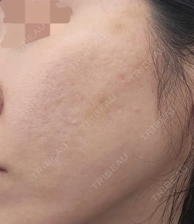 肌育注射（ジュベルックなど） L‘amour clinic Tokyo【ラムールクリニック東京】 DAY 7 メイン用