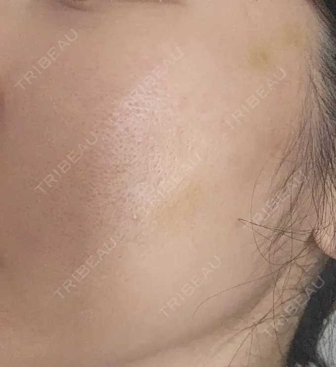 肌育注射（ジュベルックなど） L‘amour clinic Tokyo【ラムールクリニック東京】 DAY 8 メイン用