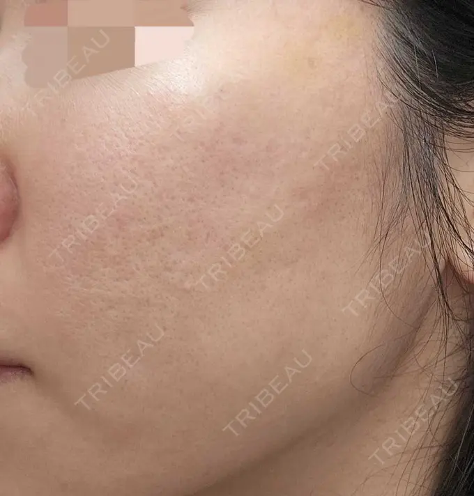 肌育注射（ジュベルックなど） L‘amour clinic Tokyo【ラムールクリニック東京】 DAY 10 メイン用