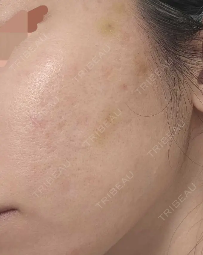 肌育注射（ジュベルックなど） L‘amour clinic Tokyo【ラムールクリニック東京】 DAY 5 メイン用