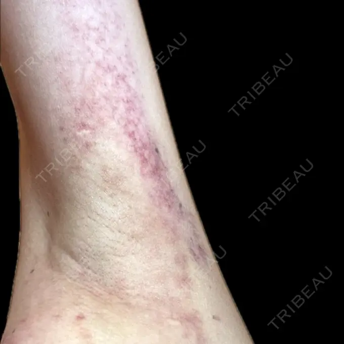 ワキ汗治療（レーザー） Fellez Clinic【フェルズクリニック】 DAY 3 メイン用