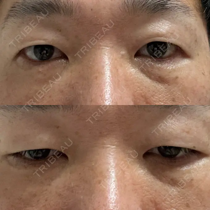 クマ治療 / 下まぶたの脂肪取り ROOTS Clinic DAY 4 メイン用